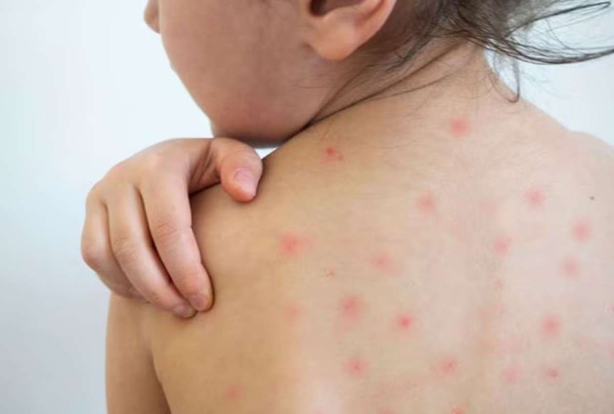 Ministerio de Salud P&uacute;blica confirma cero casos y despliega protocolos por riesgo de sarampi&oacute;n