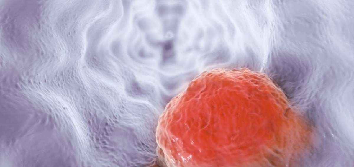 La multiplicaci&oacute;n de las c&eacute;lulas cancerosas podr&iacute;a ser prevenida usando una droga disponible en el mercado, el fostamatinib
