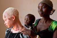 Al menos 11 muertos en una protesta por el ataque a un niño albino en Madagascar