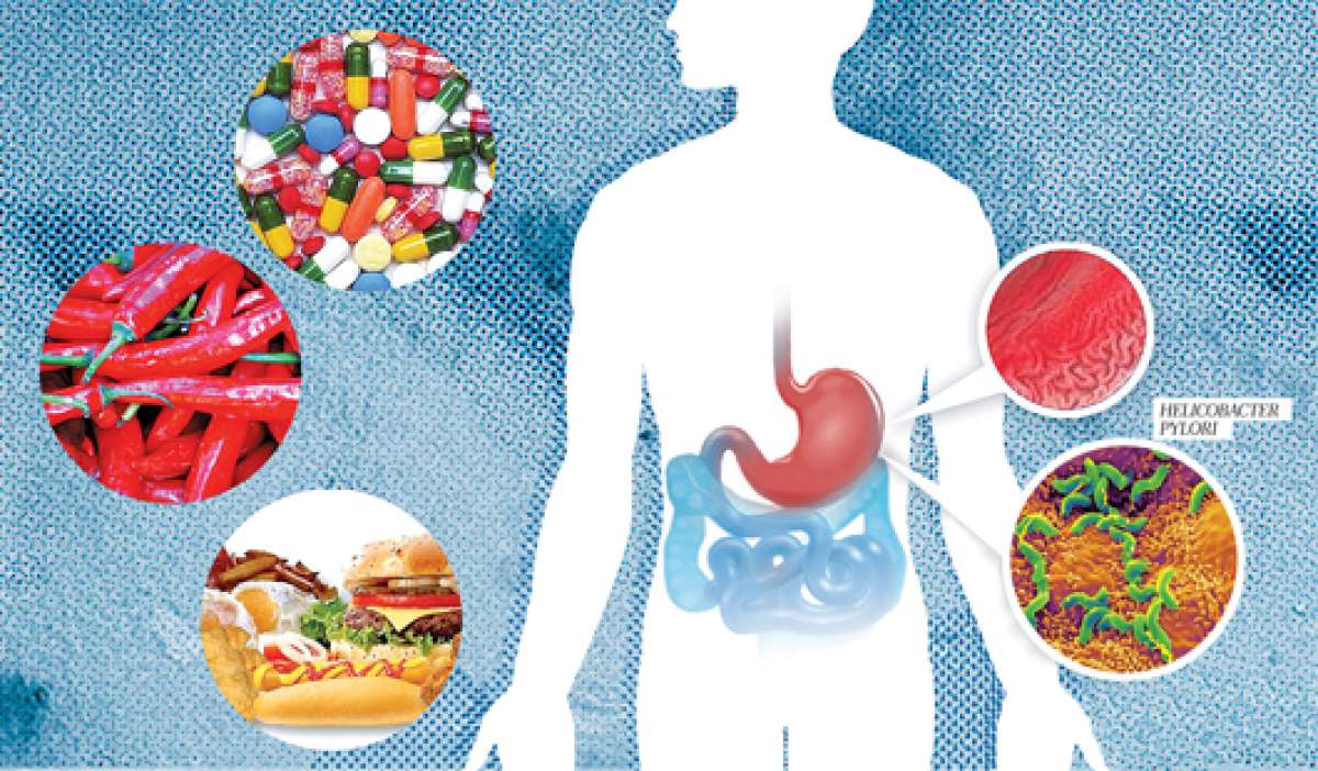 El grupo etario que desarrolla gastritis hoy es menor de 20 a&ntilde;os