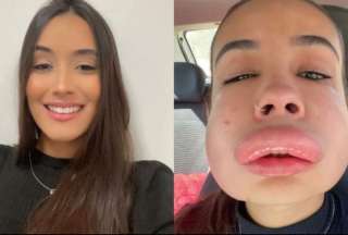 La influencer brasileña Isis de Olivera Almeida Pinheiro sufrió una reacción alérgica a un procedimiento estético.