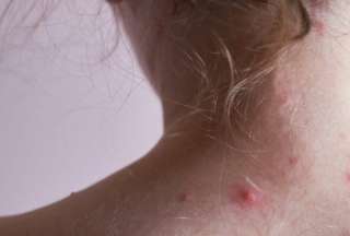 Los principales síntomas de la varicela son fiebre, dolor de cabeza, granos y más. 